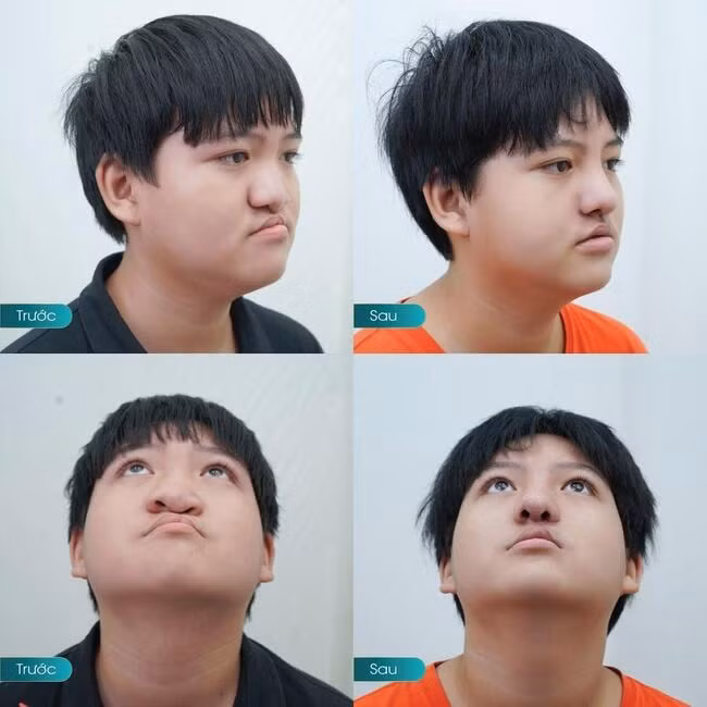 Châu Tùng tự tin với diện mạo mới sau 1 tháng sửa mũi môi