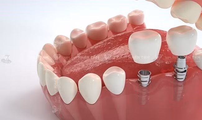 Trồng răng Implant giá bao nhiêu được nhiều khách hàng quan tâm Trồng răng Implant giá bao nhiêu được nhiều khách hàng quan tâm