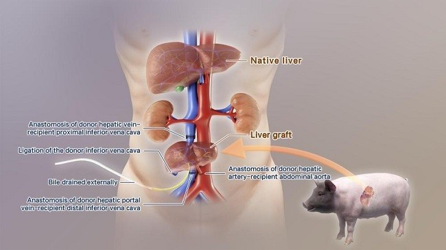 Sơ đồ mô phỏng quá trình ghép gan lợn chỉnh sửa gen vào cơ thể người trong nghiên cứu này. Ảnh Tân Hoa Xã