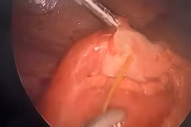 Phẫu thuật thành công ca viêm phúc mạc do xương cá đâm thủng ruột