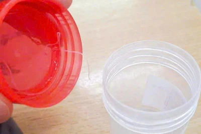 Ký sinh trùng 10 cm sống trong mắt bệnh nhân