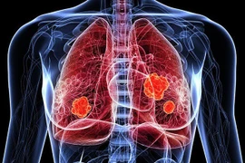 Thuốc Datroway được FDA chấp thuận trong điều trị ung thư phổi không tế bào nhỏ. (Ảnh: Pharmaceutical-technology.com)