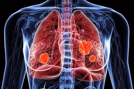 Thuốc Datroway được FDA chấp thuận trong điều trị ung thư phổi không tế bào nhỏ. (Ảnh: Pharmaceutical-technology.com)