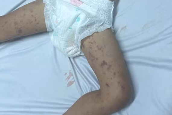 Xuất hiện viêm não mô cầu, Đắk Lắk khẩn trương truy vết người tiếp xúc