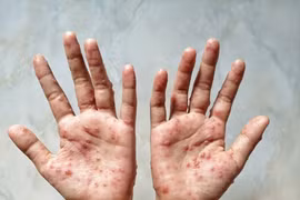 Campuchia ghi nhận thêm 3 ca mắc bệnh đậu mùa khỉ