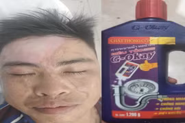 Bị bỏng nặng vùng mặt do dùng chai nước thông cống
