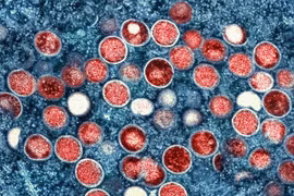 Đậu mùa khỉ bùng phát ở Nam Phi sau hơn 1 tháng phát hiện ca bệnh đầu tiên, 1 người tử vong