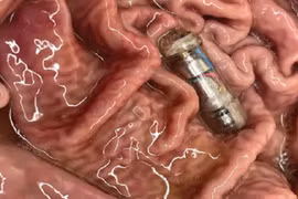 'Viên thuốc' công nghệ có khả năng tạo cảm giác no bụng