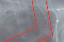 Vụ mổ nhầm ở Lâm Đồng: Xem xét nguyện vọng người bệnh