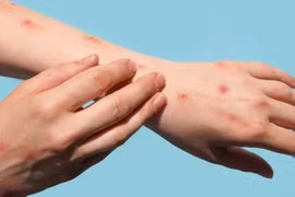 WHO triệu tập họp khẩn vì bệnh đậu mùa khỉ lây lan nhanh chóng