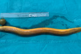 Thủng trực tràng vì nhét con lươn sống và quả chanh vào hậu môn