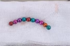 Bé trai thủng ruột do nuốt phải chuỗi hạt nam châm