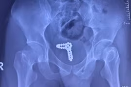 “Tự sướng” bằng chuỗi bi kim loại, nam thanh niên nhập viện