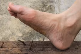 Người đàn ông nguy kịch sau 2 tuần giẫm phải đinh gỉ