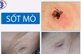 Sốt cả tuần không đỡ, nhập viện phát hiện bị sốt mò