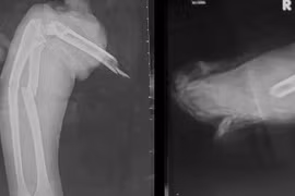 Tay áo khoác cuốn vào bánh xe, bé gái bị kéo đứt lìa cánh tay