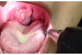 Bệnh bạch hầu: Triệu chứng, biến chứng và cách phòng tránh