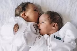 Người phụ nữ mang thai ở 2 tử cung, sinh 2 bé gái khác ngày