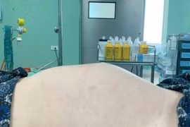 Thiếu nữ 18 tuổi bụng to như mang thai 7 tháng, không ngờ u buồng trứng 'khủng'