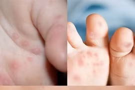 Ghi nhận bệnh nhi thứ 4 ở Đắk Lắk tử vong vì bệnh tay chân miệng