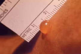 Bệnh nhi đầu tiên ở miền nam mắc bệnh sốt mò nguy kịch