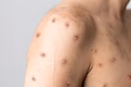 Triệu chứng đầu tiên khi mắc bệnh đậu mùa khỉ là gì?