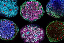 Tập thể thao 30 phút/ ngày có thể tiêu diệt khối u trong máu của bệnh nhân ung thư