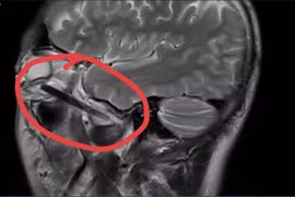 Bình Dương: Người đàn ông bị đầu đũa dài 6cm đâm sâu vào hốc mắt