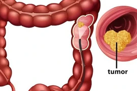 Loại quả ngon ngọt được phát hiện có khả năng ngăn chặn ung thư đại trực tràng