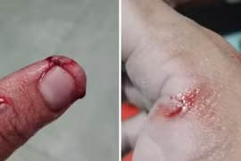 Người đàn ông tử vong sau khi bị chó nhà cắn