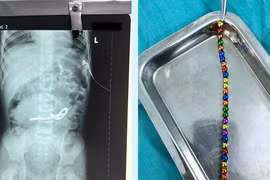 Nuốt hơn 30 viên nam châm, bé trai thủng 8 lỗ ở ruột