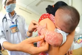 Bệnh sởi rình rập bùng phát, Bộ Y tế chỉ đạo khẩn