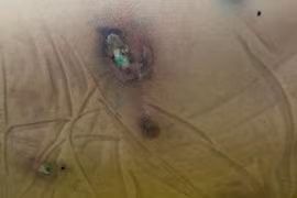 Xuất hiện ca bệnh nhiễm vi khuẩn gây tiêu xương