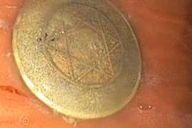 Bé 4 tuổi nuốt đồng xu, bác sĩ cảnh báo tai nạn dị vật cận tết