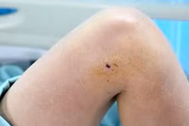 Bị gà trống tấn công, người phụ nữ phải nhập viện cấp cứu