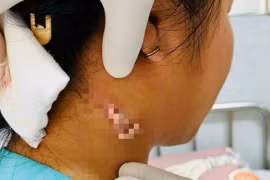 Đồng Nai: Phát hiện ca bệnh nhiễm vi khuẩn 'ăn thịt người'