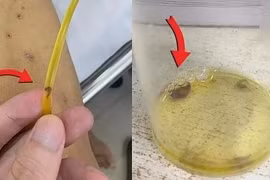 Bùng nổ ca bệnh nhiễm giun lây từ thú cưng