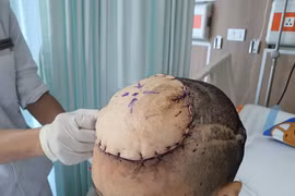 Người phụ nữ mọc thêm "chiếc đầu thứ hai" 