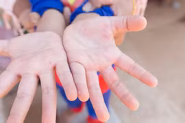 40% trẻ mắc bệnh tay chân miệng do chủng virus nguy hiểm