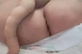 Hy hữu: Bé trai 4 tháng tuổi có 'đuôi' dài 14 cm