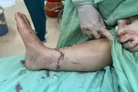 Phẫu thuật nối liền bàn chân bị đứt rời cho bệnh nhân bị tai nạn giao thông ở Đắk Lắk