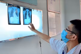 Khám sàng lọc bệnh lao tại huyện Chư Prông