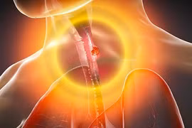 Những phát hiện khoa học mới giúp điều trị ung thư thực quản