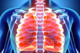 Người thứ 2 được chữa khỏi ung thư phổi giai đoạn cuối