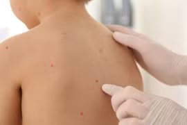 Thủy đậu một trong những bệnh dễ lây nhất