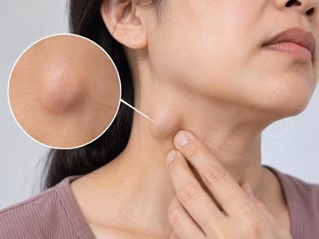 Người mắc nên đi khám nếu sau khoảng 2 - 4 tuần, hạch ở cổ vẫn tồn tại và tiếp tục lớn lên. Ảnh minh hoạ: N.Quý tạo từ ChatGPT