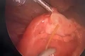 Phẫu thuật thành công ca viêm phúc mạc do xương cá đâm thủng ruột