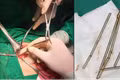 Bệnh viện Đa khoa Trung tâm tỉnh Gia Lai phẫu thuật thành công lấy 25 viên nam châm trong đường tiêu hóa bệnh nhi.