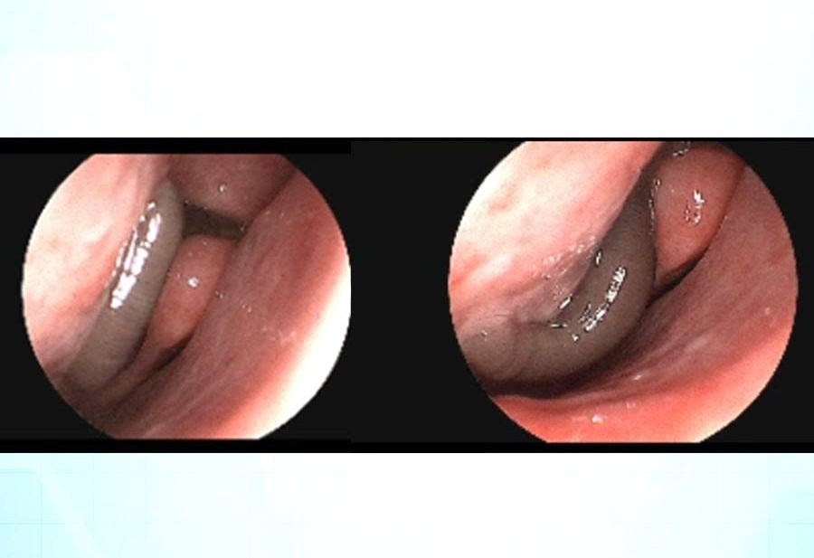 Hình ảnh nội soi dị vật là 1 con vắt trong mũi bệnh nhân Đ.V.H. Ảnh: M.H 2.jpg