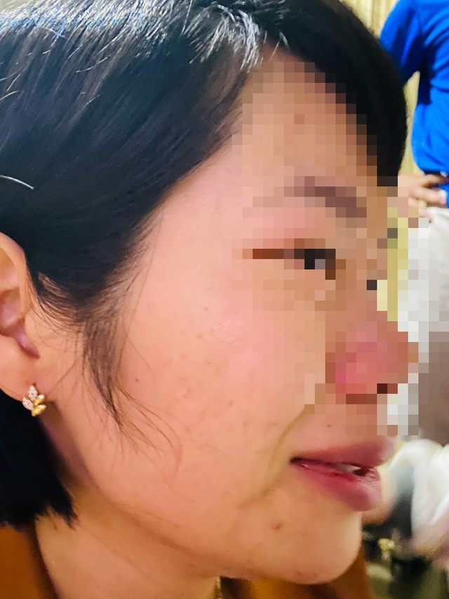 Đắk Nông: Con bị hạnh kiểm trung bình, phụ huynh đến nhà đánh cô giáo - Ảnh 1. Hình ảnh cô giáo Q. bị đánh. Ảnh: NVCC